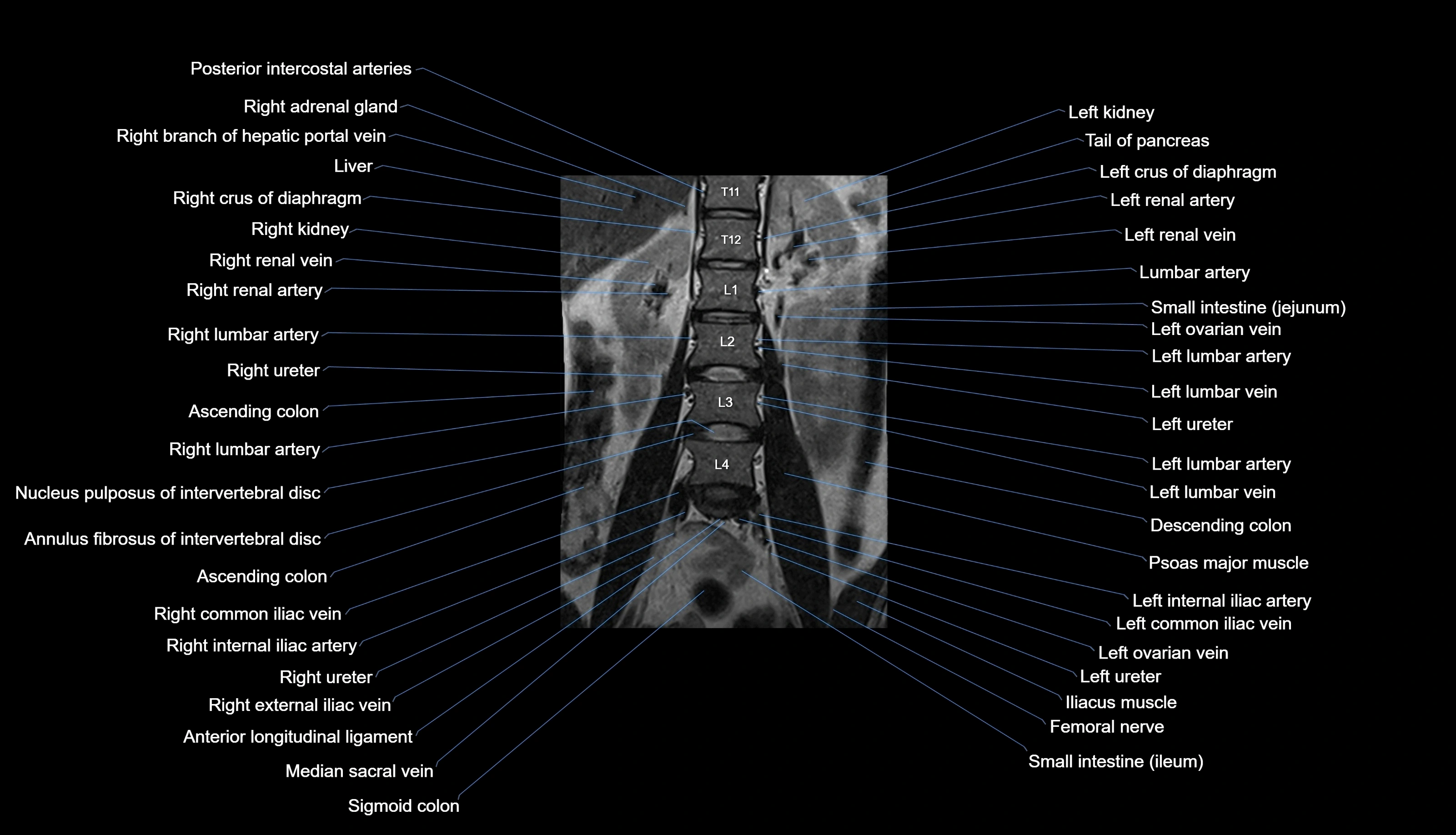 MRI lumbar spine labelled coronal cross sectional anatomy 3T radiology-img-00001-00009.webp